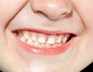 Как сохранить детские зубы: советы стоматолога